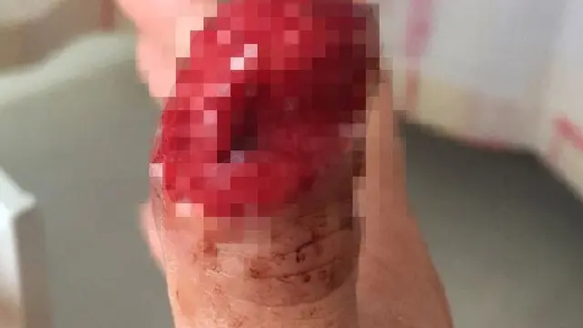 Akibat Luka Karena Cabut Kuku Palsu, Jempol Wanita Ini Diamputasi