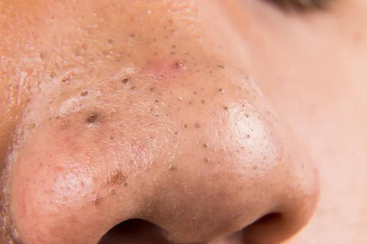 Cara Membuat Pore Pack Alami untuk Angkat Komedo Hanya dengan 3 Bahan