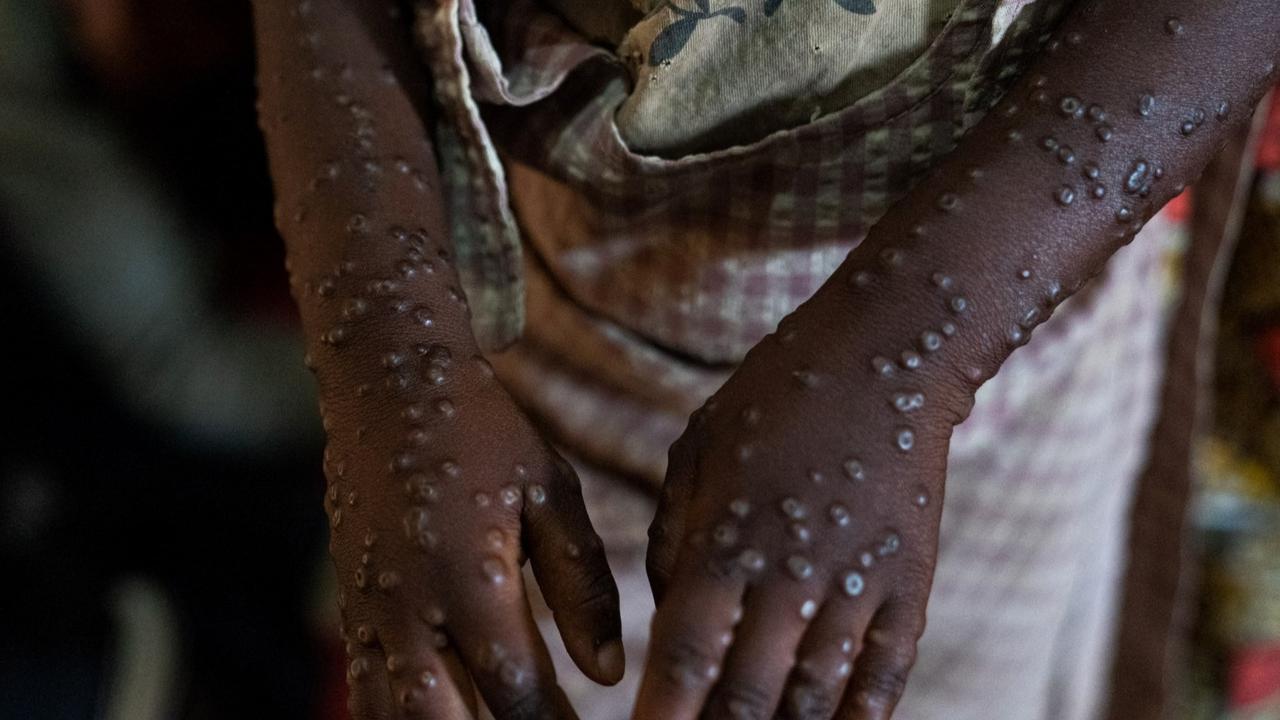 Dokter Sebut Mpox Bisa Picu Penyakit Komplikasi Serius