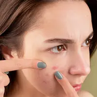 Ilustrasi kulit berjerawat. (dok. pexels/Anna Nekrashevich)