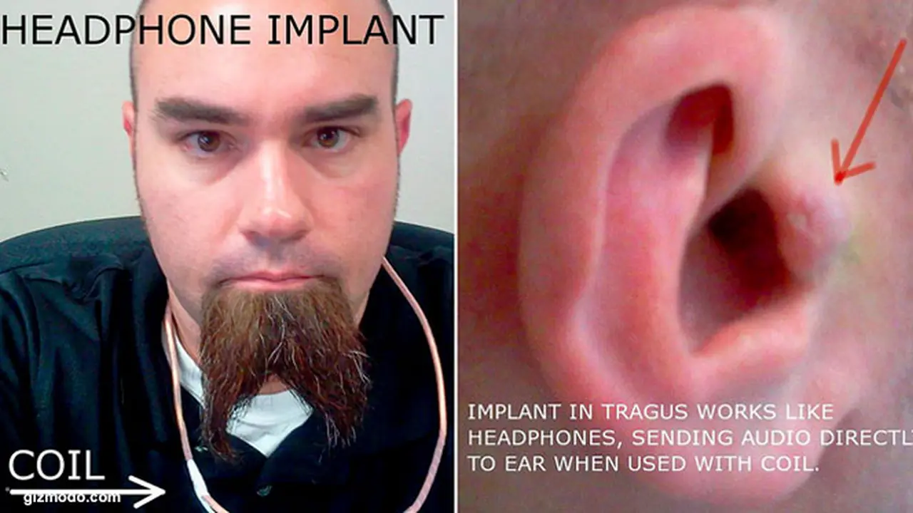 implant-130628b.jpg