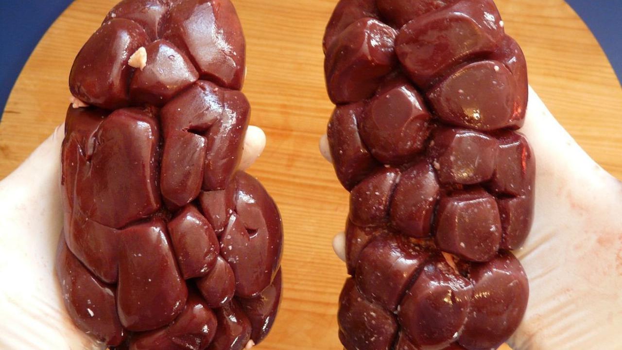 Penyebab Batu Ginjal