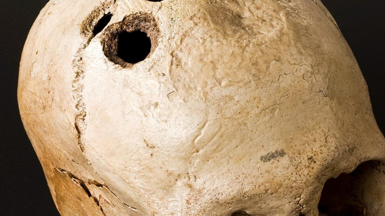 Trepanasi, Metode Pengobatan Kuno yang Mengerikan dan Melubangi Kepala