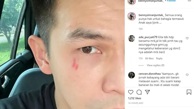Foto Jonathan Frizzy dengan bekas luka cakar yang diunggah Benny Simanjuntak (https://www.instagram.com/p/CUC3kajpDT1/)