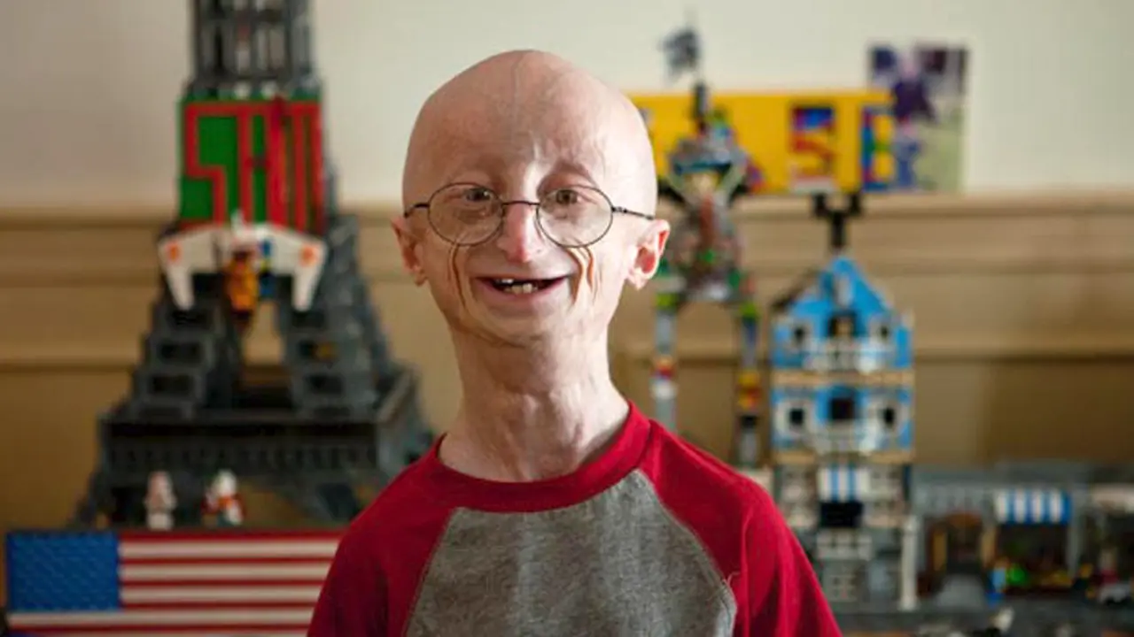 Progeria, si Kecil dengan Muka Tua Karena Kelainan Genetis