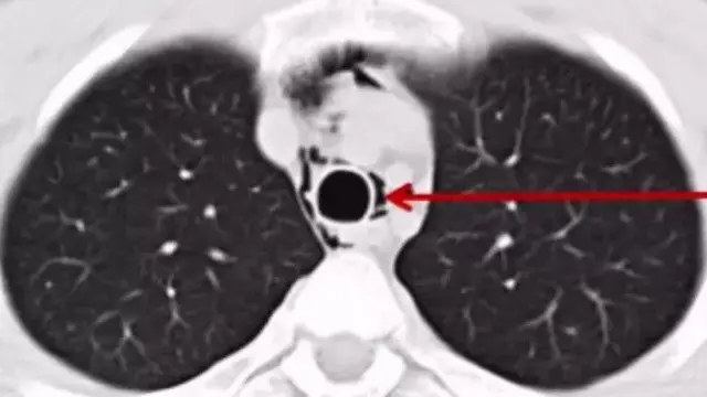 Pneumothorax