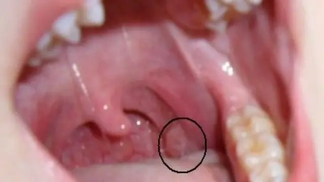 Kanker tengah tenggorokan (oropharyngeal)