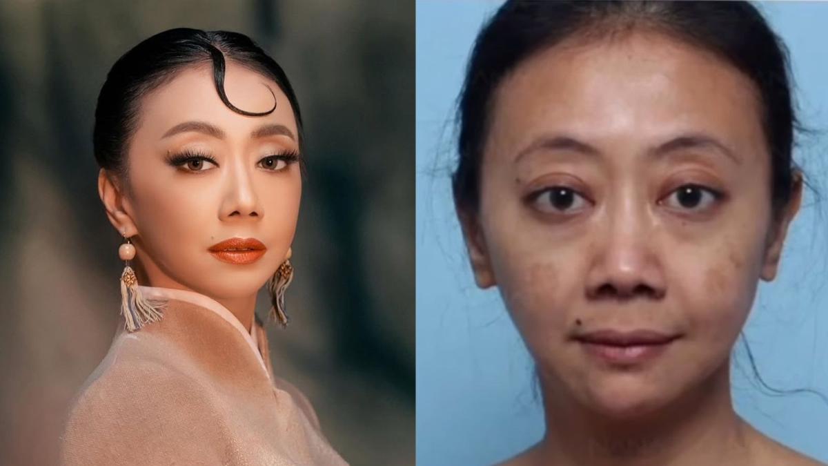 Tampilan Asri Welas Sebelum dan Sesudah Jalani Operasi Plastik di Korea Selatan