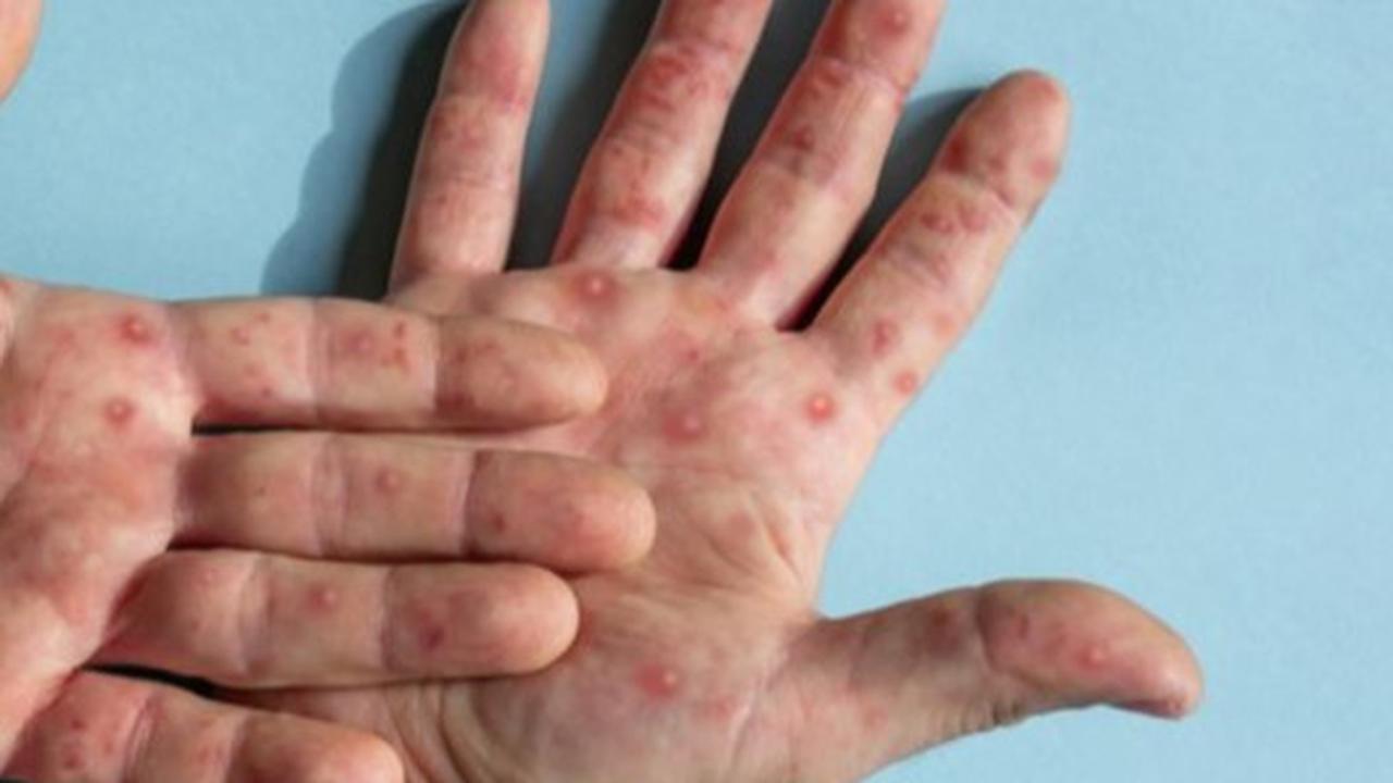 Mitos Sakit Cacar Tak Boleh Mandi, Dokter Spesialis Kulit Jelaskan Fakta Sebenarnya