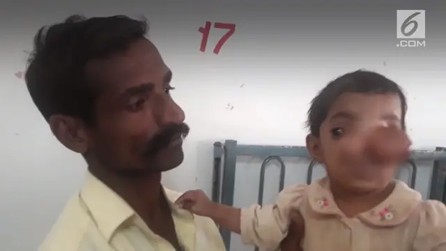 Di India seorang anak menderita sindrom aneh yang membuatnya memiliki hidung seperti belalai gajah.