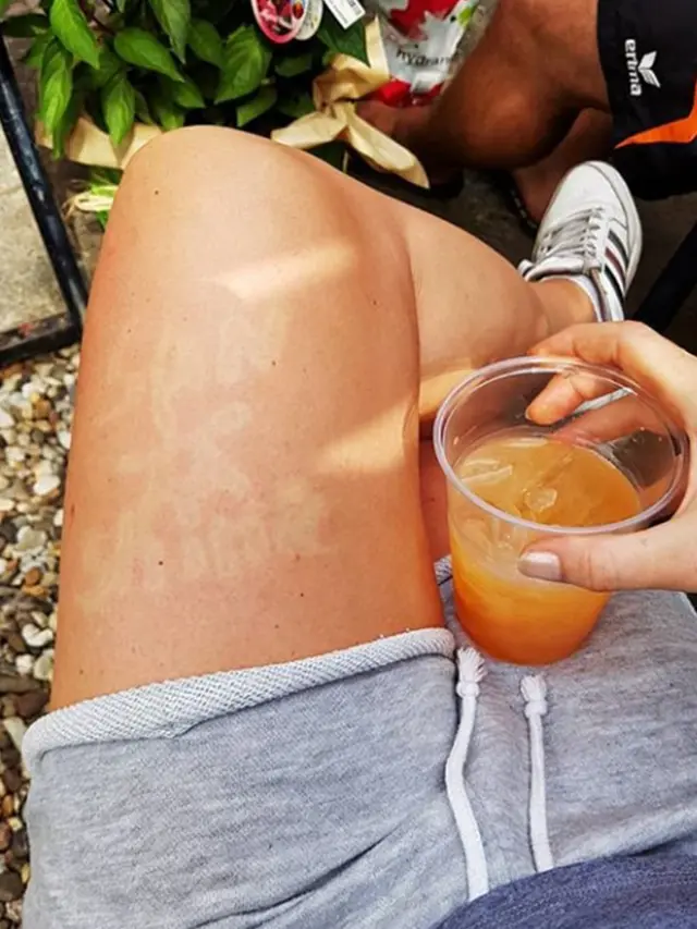 Sunburn Tattoo/Art
