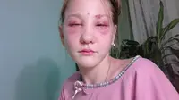 Masha Kuznetsova harus kehilangan penglihatannya dan cacat setelah mewarnai alis dan bulu matanya.
