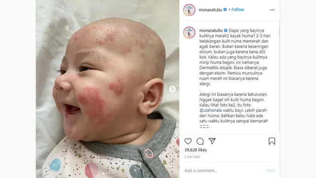 Kulit Ruam Merah, Bayi Mona Ratuliu Terkena Dermatitis Atopik