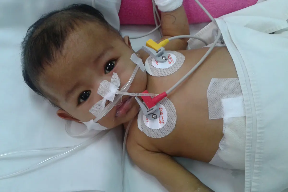 Derita Atresia Biler, Bayi Masha Butuh Bantuan