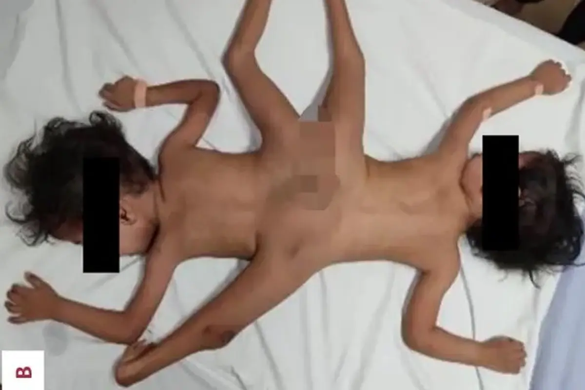 Bayi Kembar Laba-Laba Langka