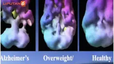 Individu dengan berat badan berlebih bukan hanya berisiko tinggi mengalami penyakit jantung, diabetes dan stroke namun juga terjadinya penyusutan otak. Setiap Indeks Massa tubuh (BMI) lebih dari 25, menyebabkan otak kiri menyusut hampir satu persen.