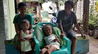 Derita Angela Skolastika Bocah Penderita Hidrosefalus di Kupang