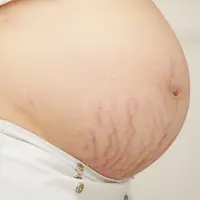 Ilustrasi Stretch Mark/https://www.shutterstock.com/baipooh