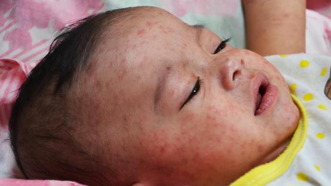 Penyakit Tampek Pada Bayi Penyabab Gejala Dan Pengobatannya Hot Liputan6 Com