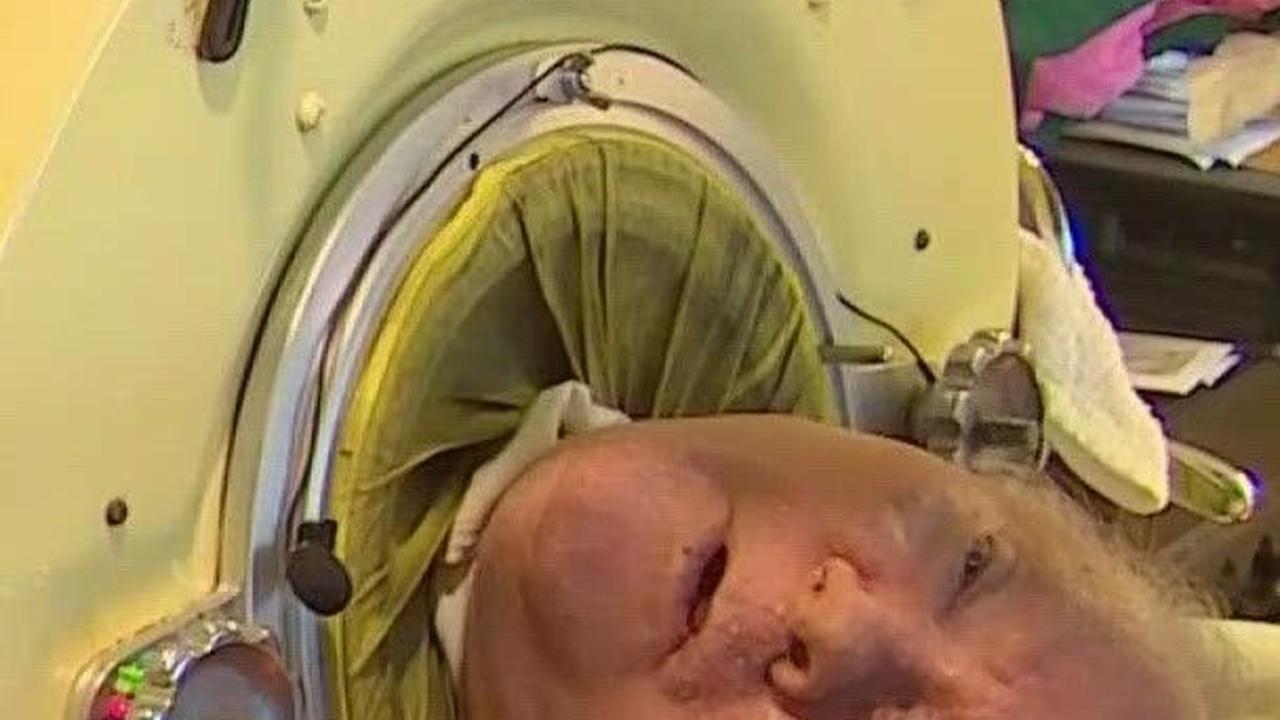 Kisah Paul Alexander, Manusia dengan Paru-Paru Besi yang Hidup Paling Lama, Meninggal di Usia 78 Tahun