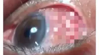 (Foto: Asia One) Dokter di India dikejutkan dengan penemuan cacing sepanjang 15 sentimeter pada mata seorang lansia.
