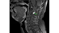 Dokter pun menyarankan jalani MRI otak dan tulang belakang. Dari hasil yang keluar diketahuilah ada tumor di belakang lehernya. (Foto: Live Science)