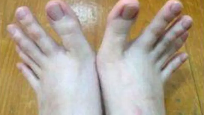 Kelainan, Jari Kaki Gadis Ini Lebih Mirip Jari Tangan!