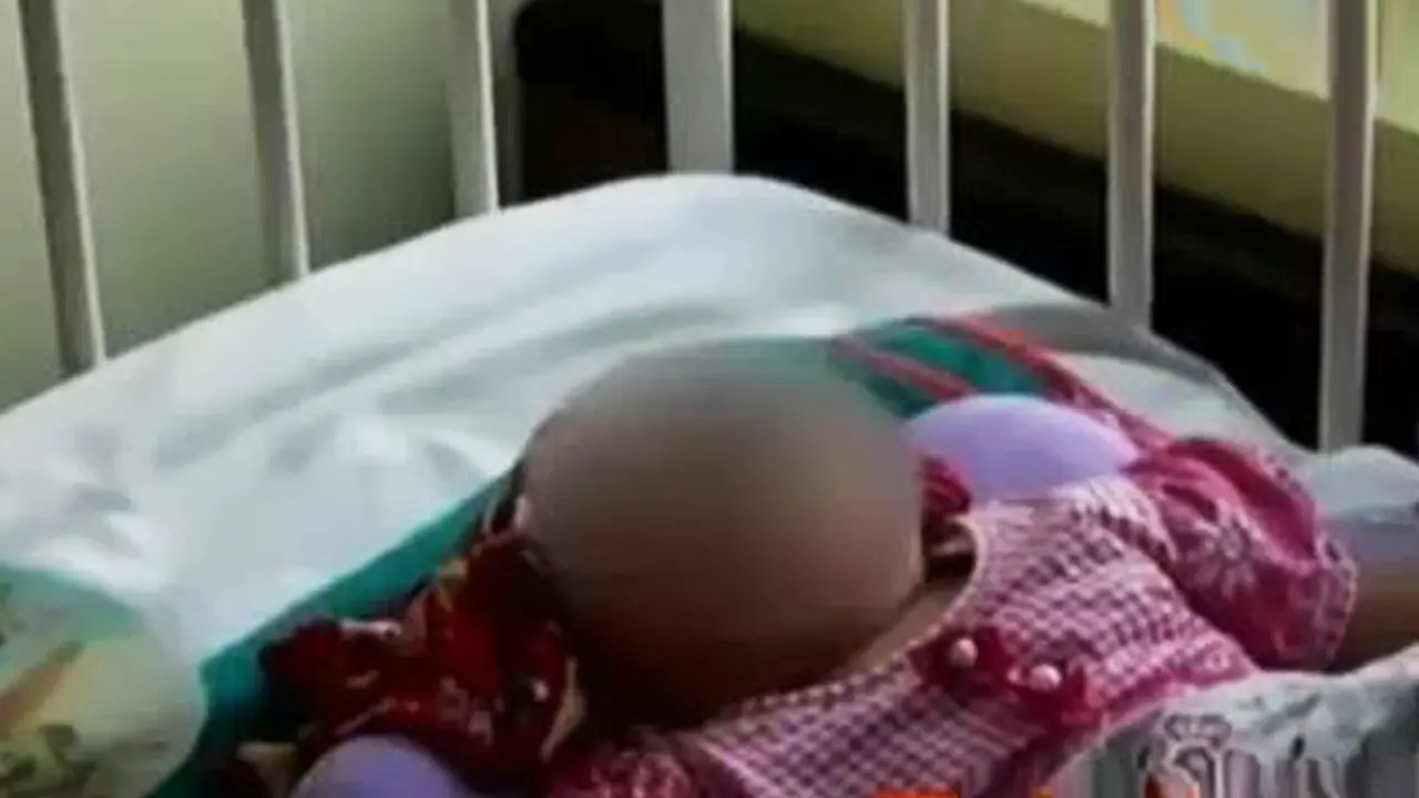 VIDEO: Aisyah, Balita Tanpa Wajah Relatif Baik Jelang Operasi