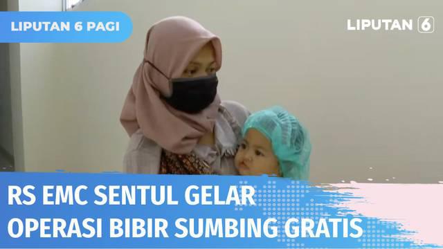 Rumah Sakit EMC Sentul, Bogor, menggelar acara bakti sosial operasi bibir sumbing gratis bagi masyarakat prasejahtera. Puluhan pasien balita mengikuti layanan operasi tersebut. Berikut edukasi kesehatan tumbuh kembangnya.