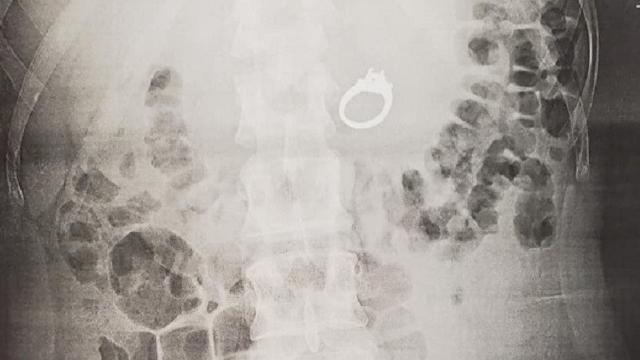 Wanita ini telan cincin dengan kondisi setengah sadar (Tangkapan Layar Facebook Jenna Evans)