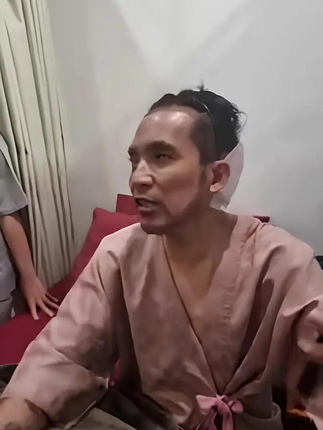 Desta Transplantasi Rambut