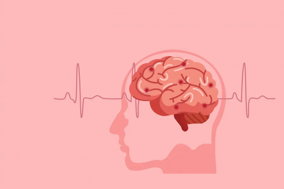 Gambar Ilustrasi Human Brain Stroke