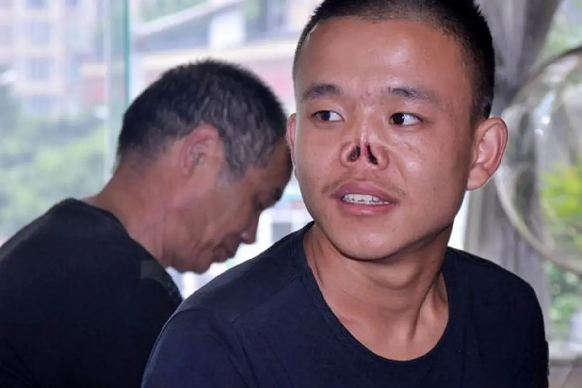 23 Tahun Hidup Tanpa Hidung, Akhirnya Pria Ini Berani Selfie
