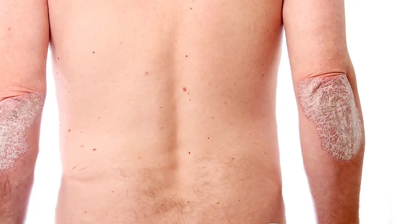 Ilustrasi penyakit psoriasis.