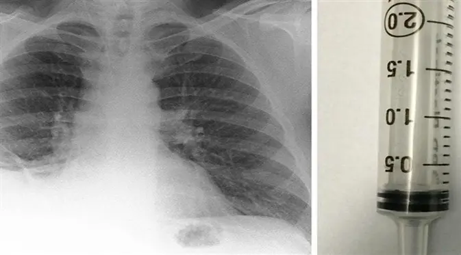 Paul sebelumnya dikira mengidap kanker paru-paru, tapi miniatur traffic cone ada di paru-parunya. (Foto: Biomedical Journal Case Reports)