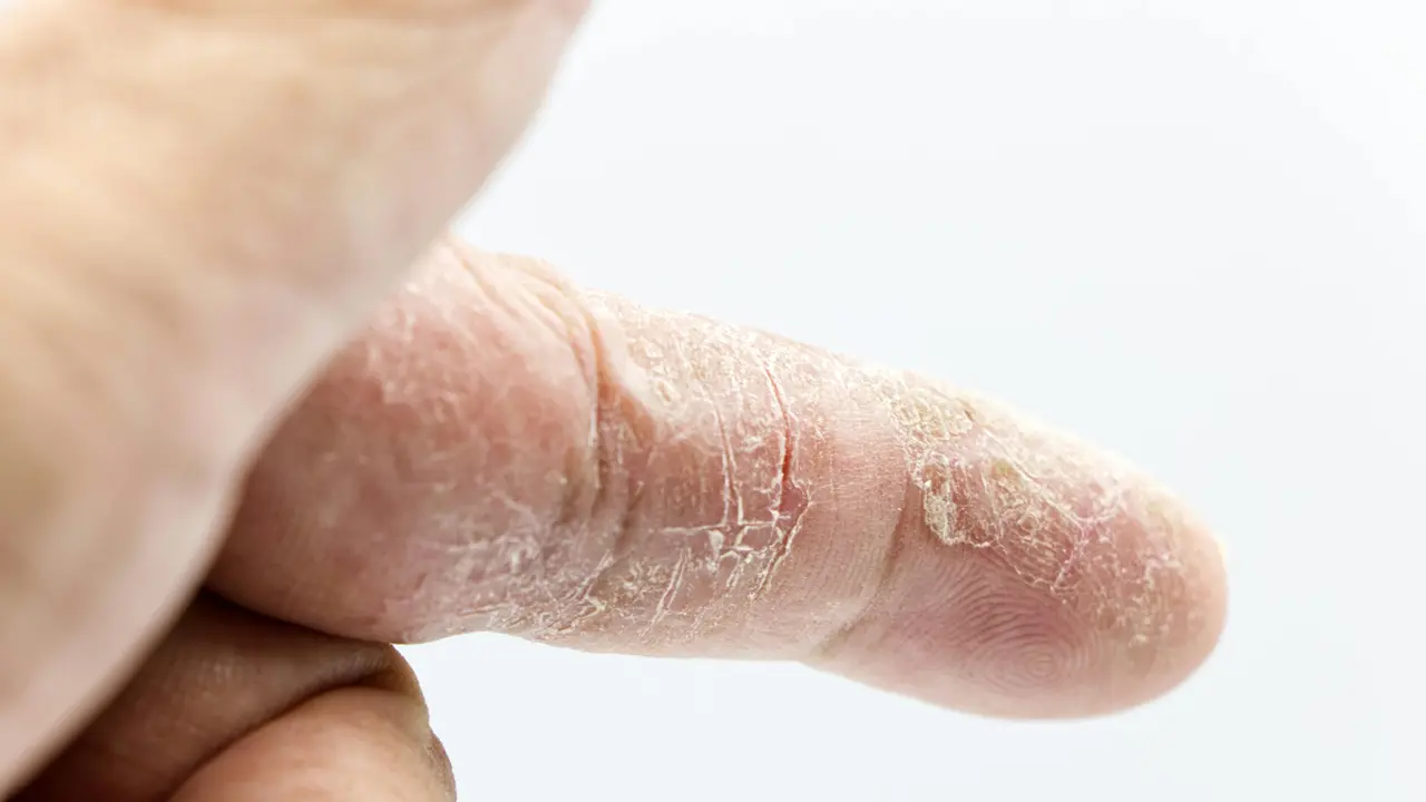 Scabies