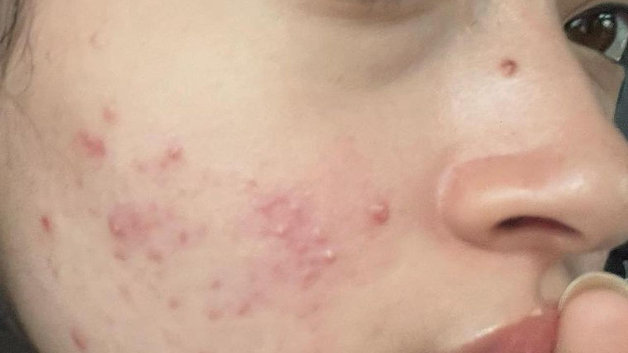 Berdasarkan unggahannya itu, adik dari aktor Bryan Domani mengungkapkan jika dirinya memiliki genetic acne. Hal serupa juga dialami oleh kakak dan ibunya.