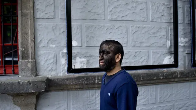 Hypertrichosis atau Hipertrikosis