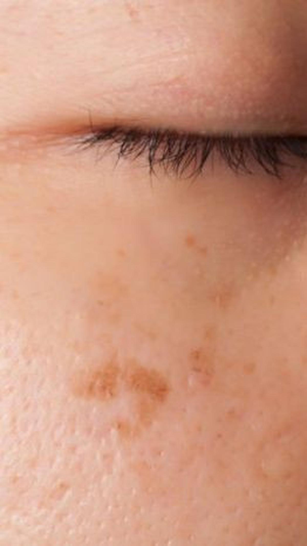 <b>3. Melasma</b><br>