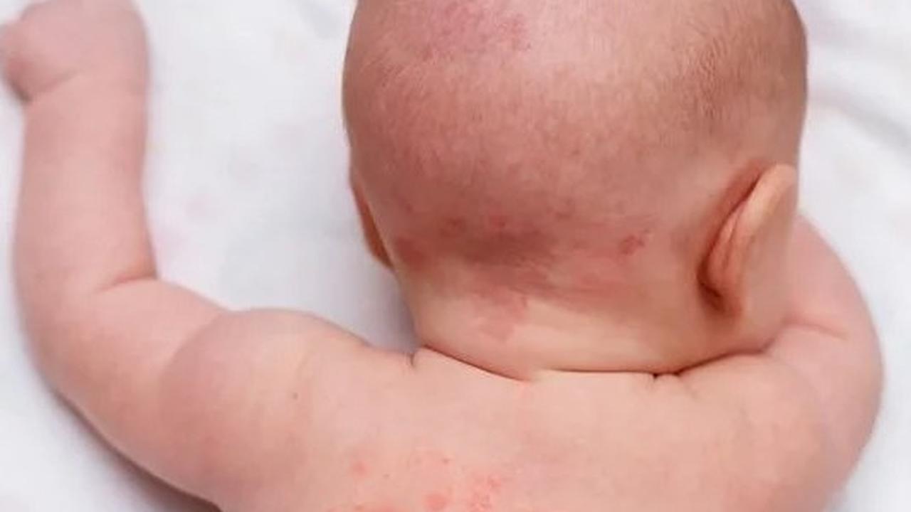 Cara Mengatasi Biang Keringat pada Anak