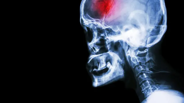 Ilustrasi stroke (iStockphoto)