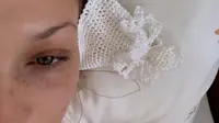 Bella Hadid Unggah Foto Lengan Diinfus, Kembali Diserang Lyme Disease?