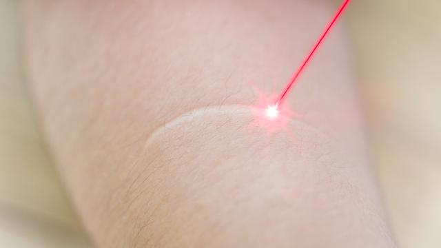 Cara Menghilangkan Keloid