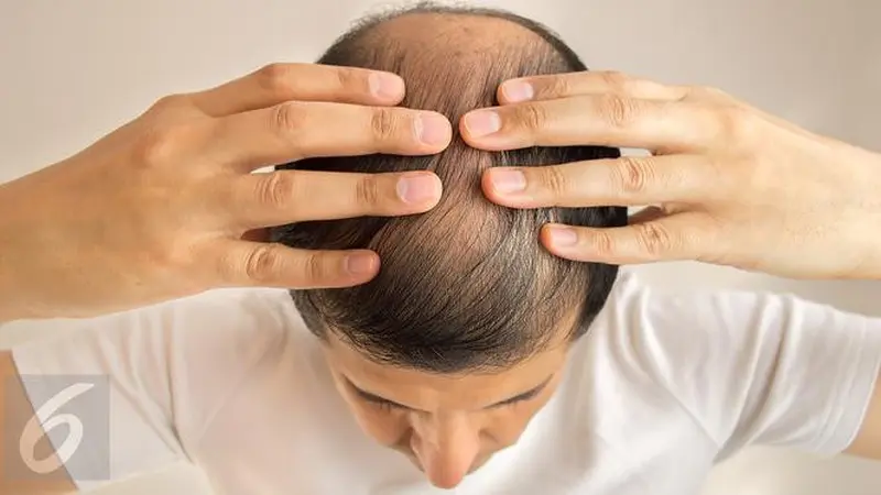 Gaya Rambut Stylish Ini Dapat Mengatasi Kebotakan Tanpa Obat