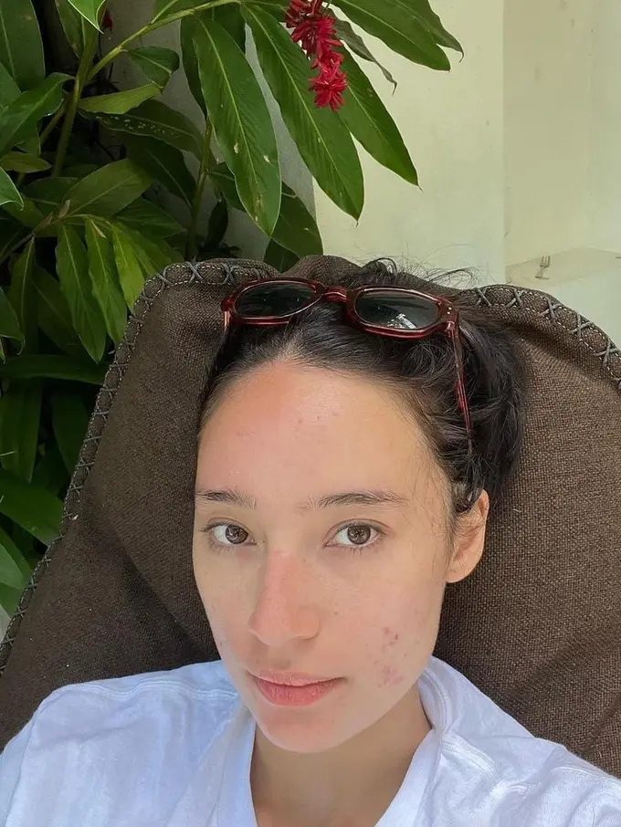 Tatjana Sapira mengunggah foto wajah penuh jerawat