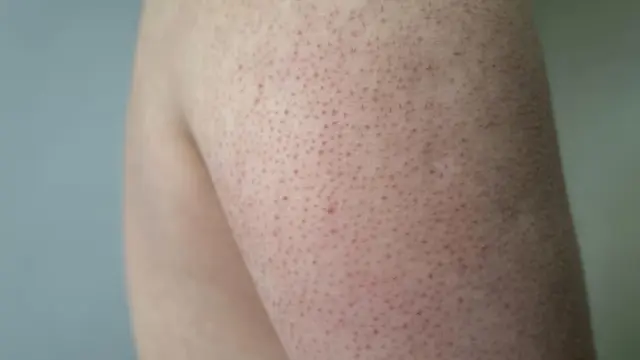 Keratosis Pilaris