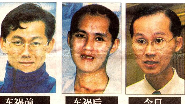 Alami Kecelakaan Tragis, Begini Perjuangan Hidup Pria dengan Otaknya yang Setengah