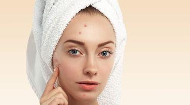 5 Faktor Penyebab Fungal Acne Dan Cara Mudah Mengatasinya Hot Liputan6 Com