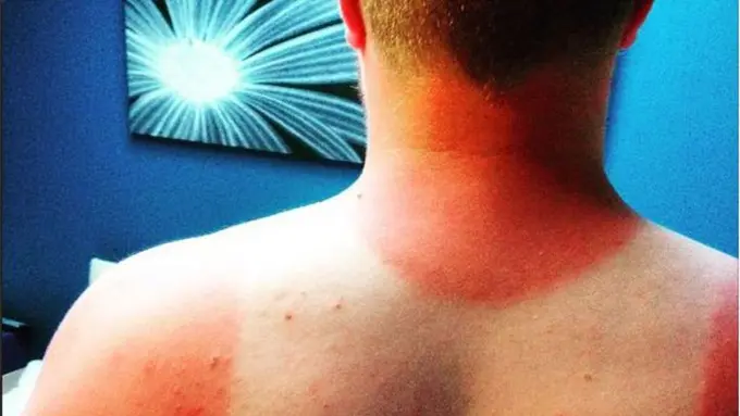 Jangan Pakai Tabir Surya Kalo Nggak Mau Kaya Orang Berikut