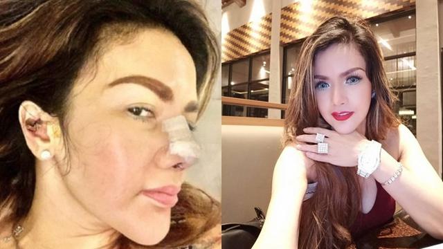 Beda Penampilan 5 Seleb Wanita Tanah Air Jalani Operasi Plastik saat Diperban Vs Setelahnya
